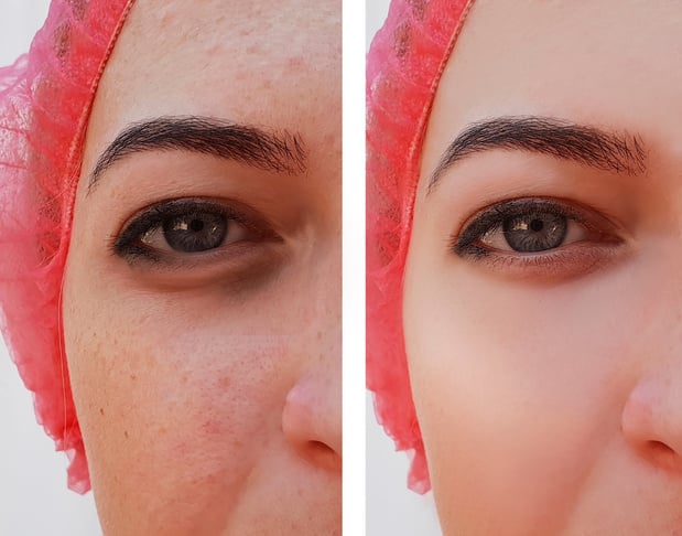 Eye swelling, wrinkles before and after cosmetic procedure, acne, pigmentation